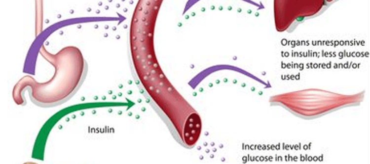 Infertility And Diabetes