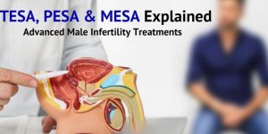 Advanced Male Infertility Treatments